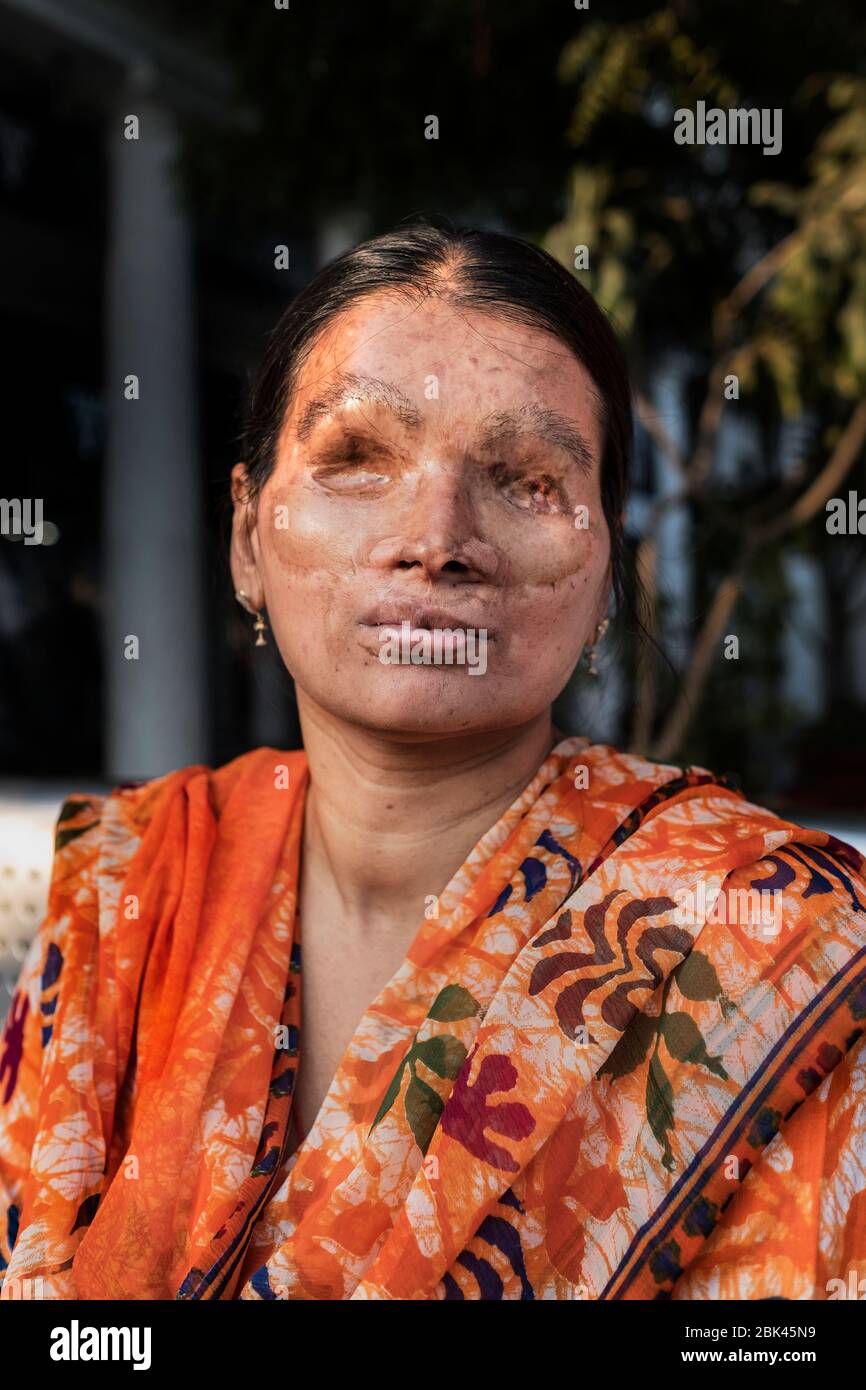 Acid attack survivor, India Stock Photo - Alamy
