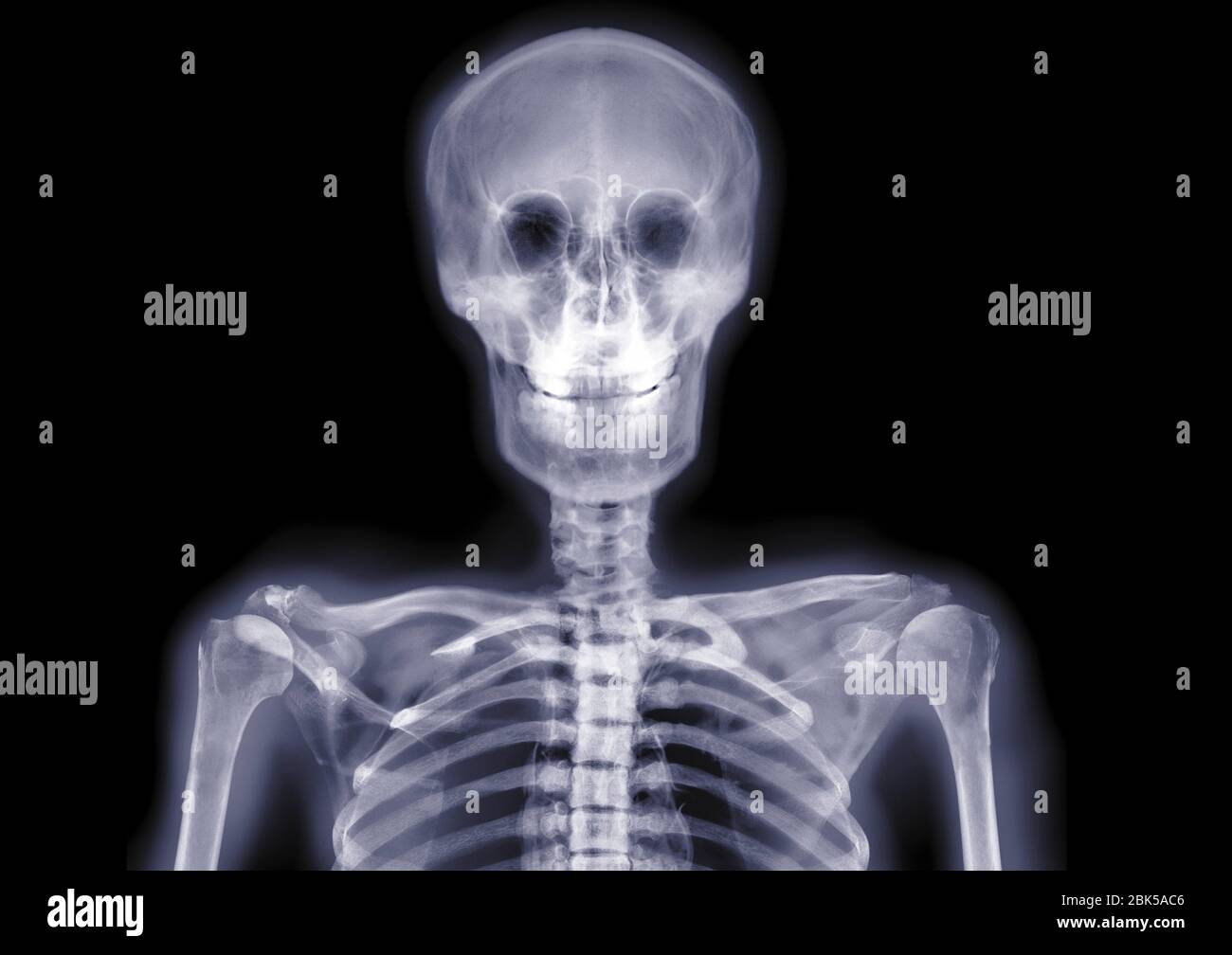 Skull and shoulders smiling, X-ray. Stock Photo