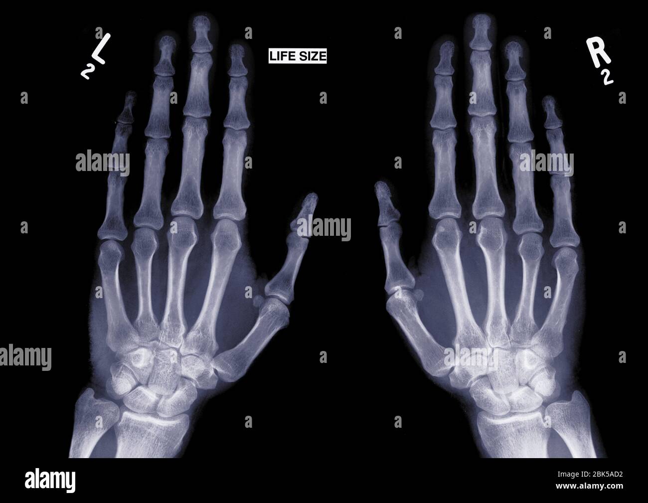 Two outstretched hands, X-ray. Stock Photo