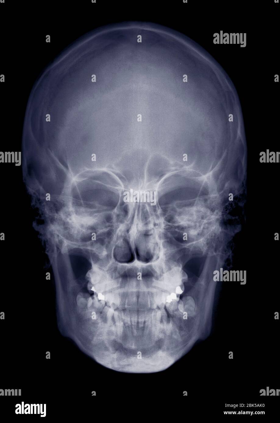 Human skull from front, X-ray. Stock Photo