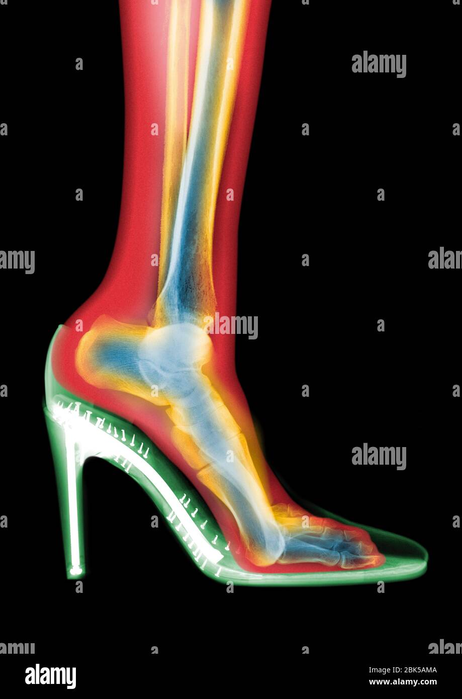 Leg in stiletto shoe, coloured MRI style X-ray. Stock Photo