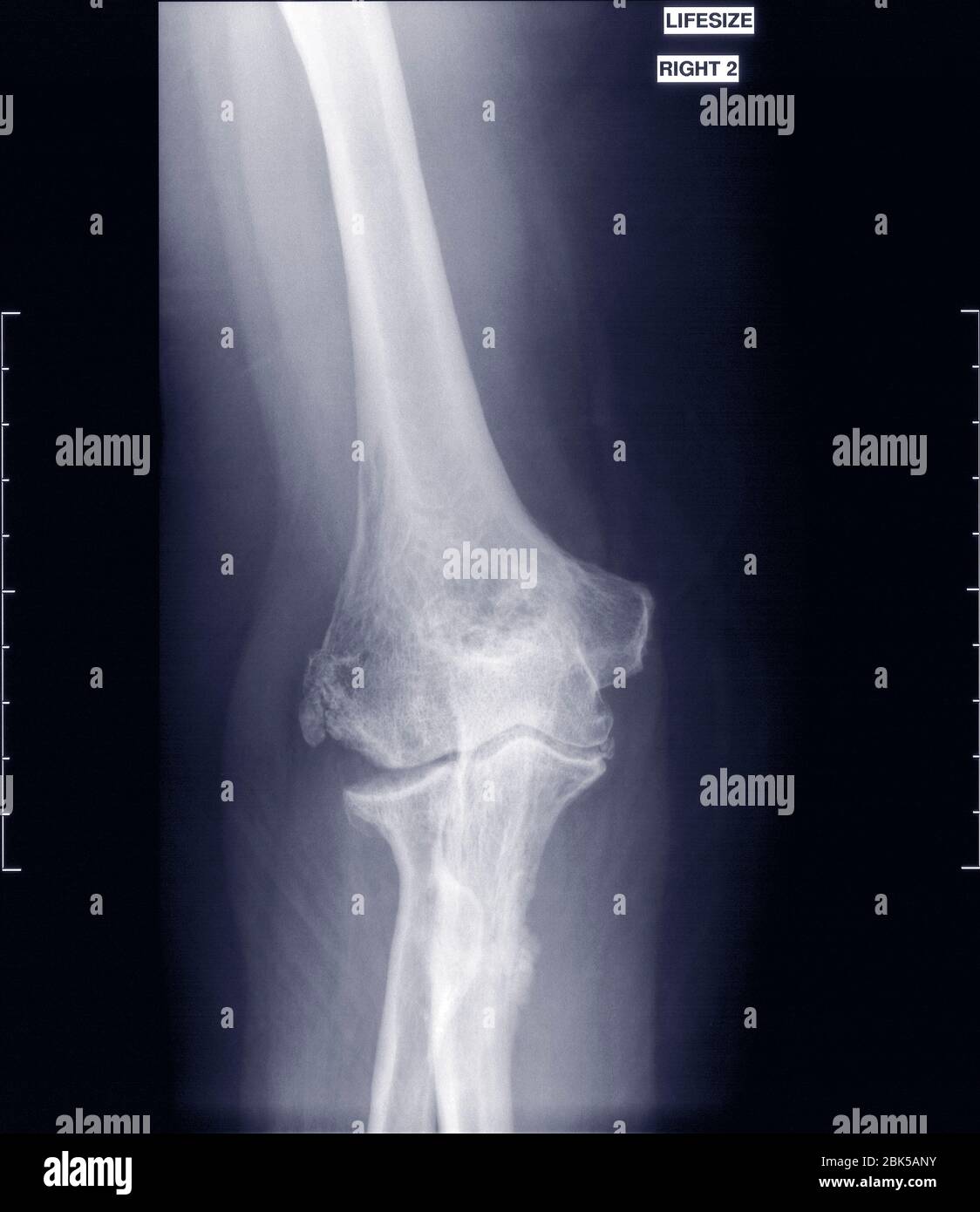 Elbow, X-ray. Stock Photo