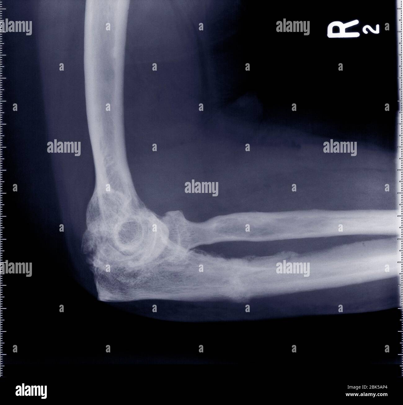 Elbow from side, X-ray. Stock Photo