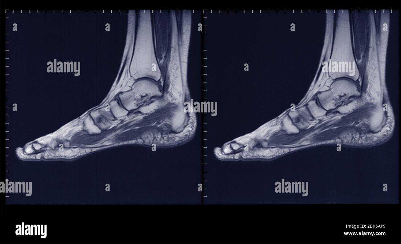 Foot and ankle, MRI Stock Photo Alamy