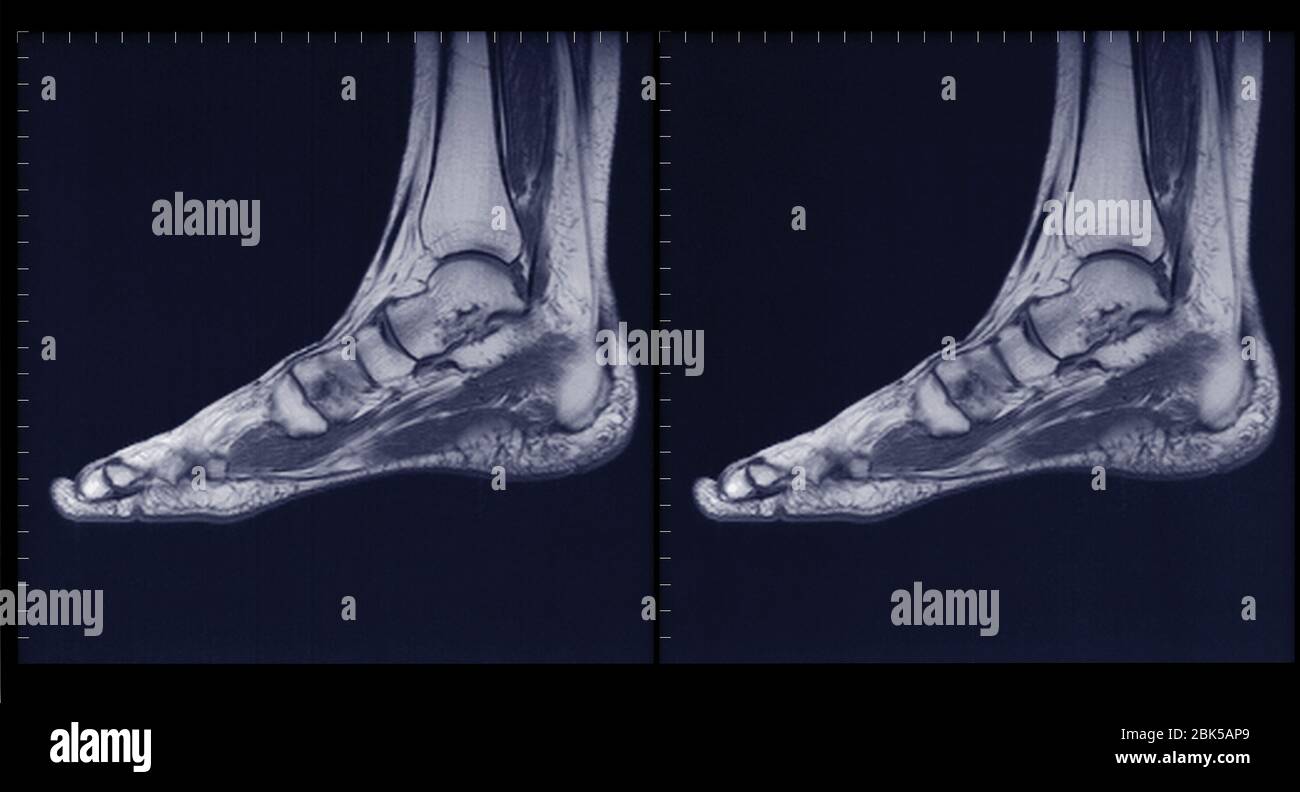 Foot and ankle, MRI. Stock Photo