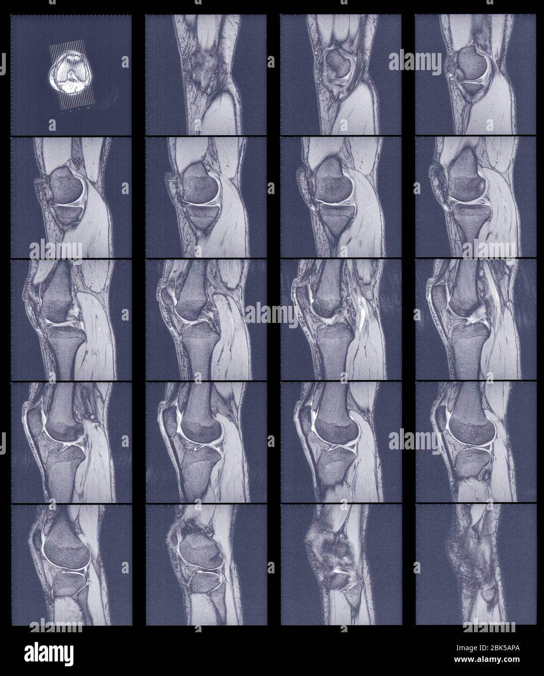 Multiple scans of knee joint, MRI. Stock Photo