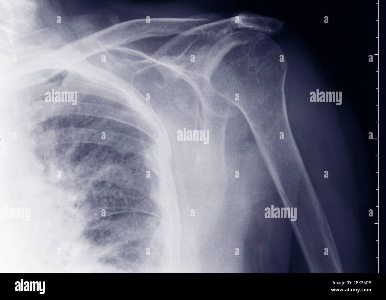 Shoulder, X-ray. Stock Photo