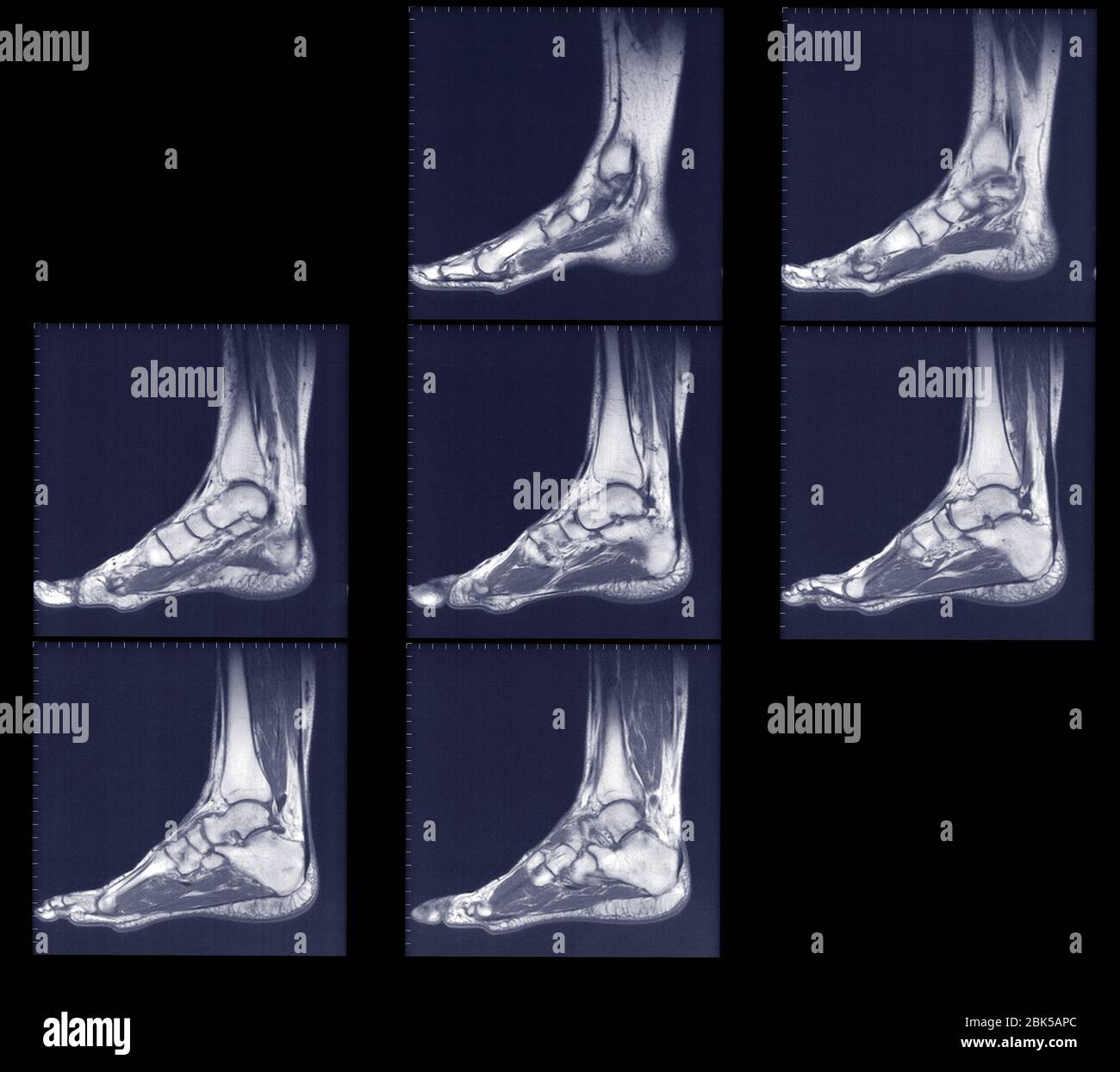 Scans of feet and ankles side, MRI. Stock Photo