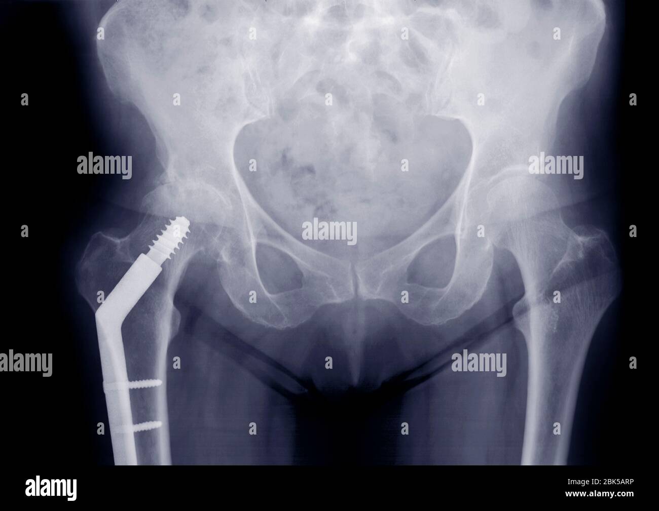 Pelvis with plated leg bone, X-ray. Stock Photo