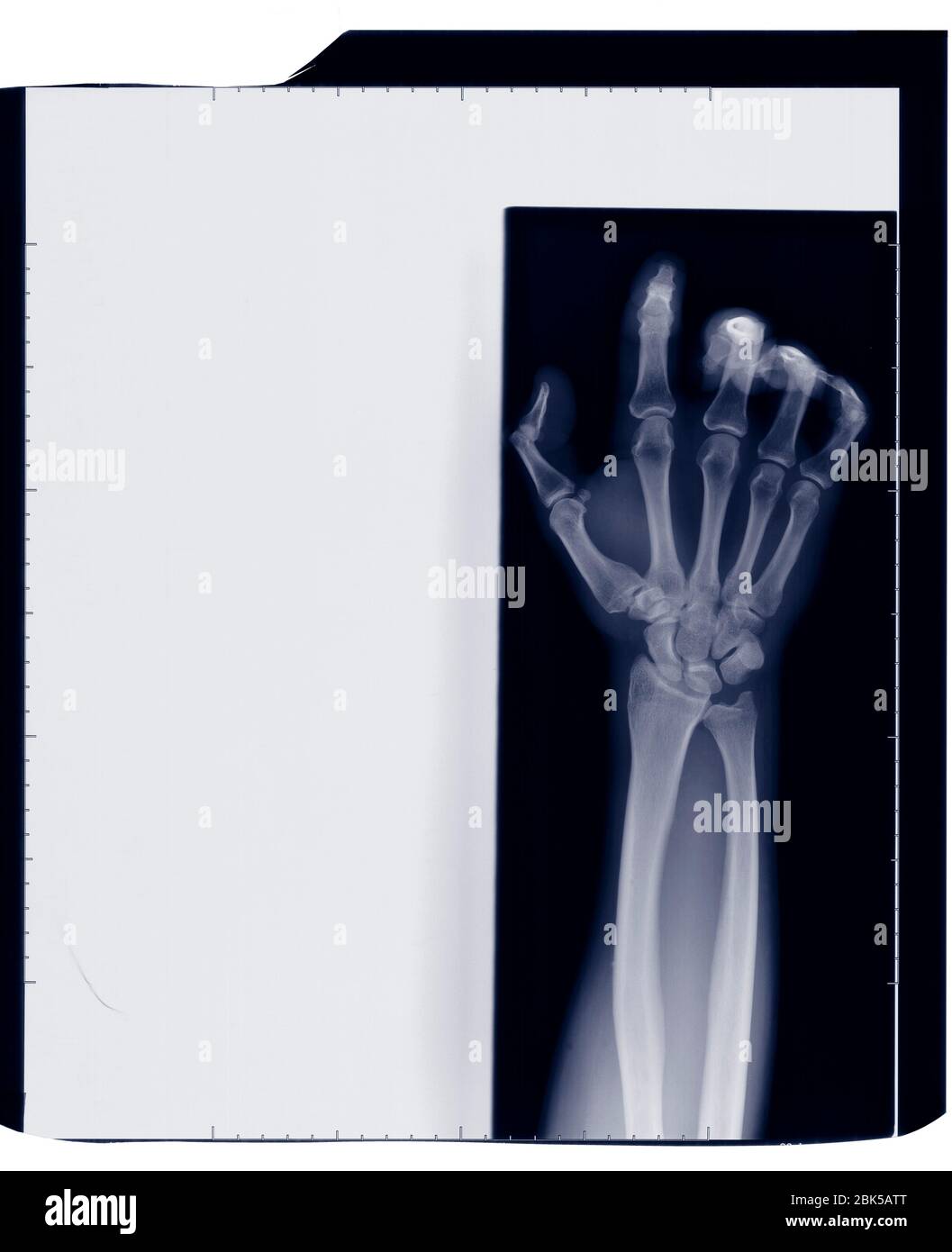 Hand and arm with curled fingers, X-ray. Stock Photo