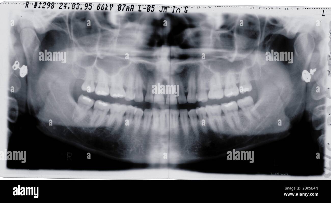 Teeth and jaw, Xray Stock Photo Alamy
