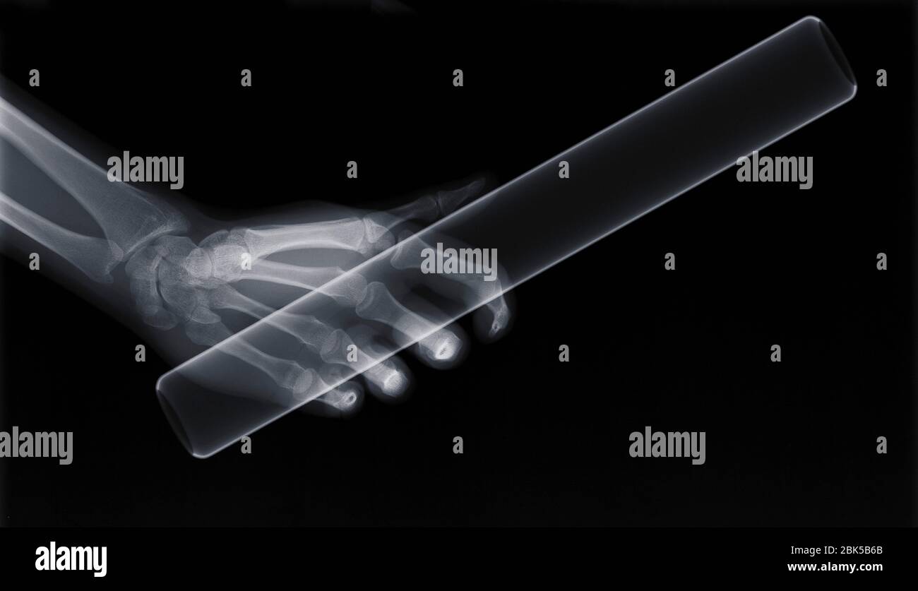 Human hand holding baton, X-ray. Stock Photo