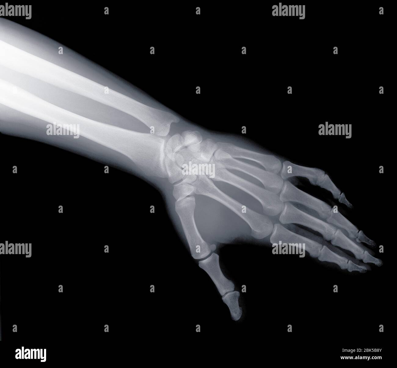 Arm and hand, X-ray. Stock Photo
