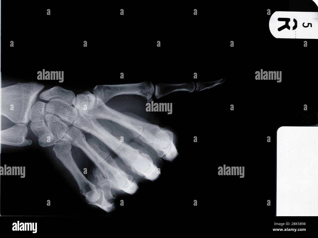 Human hand with thumb pointing, X-ray. Stock Photo