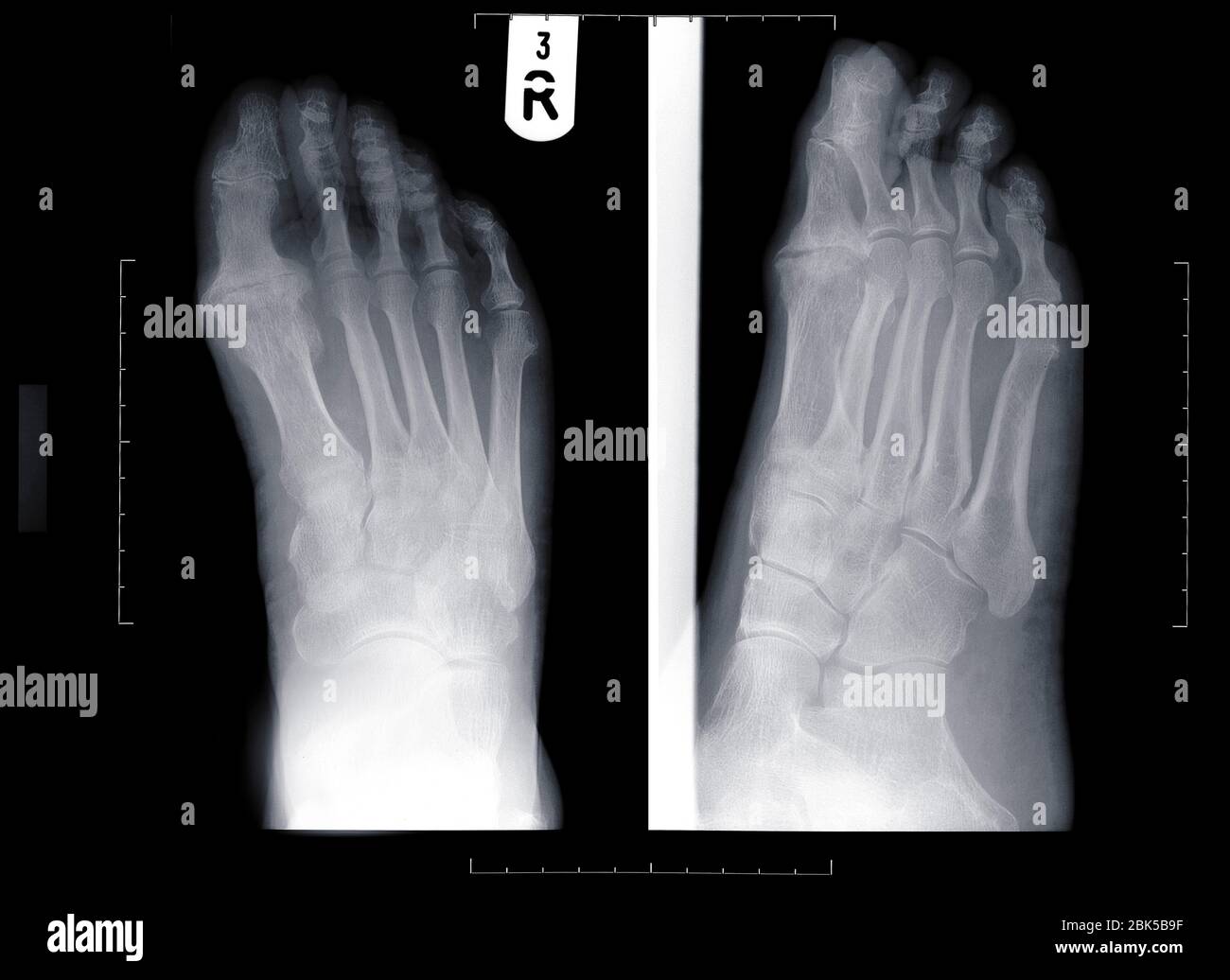 Human feet, X-ray. Stock Photo