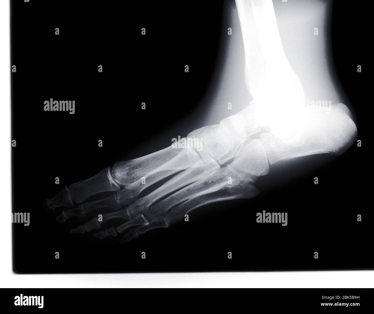Human foot, X-ray. Stock Photo