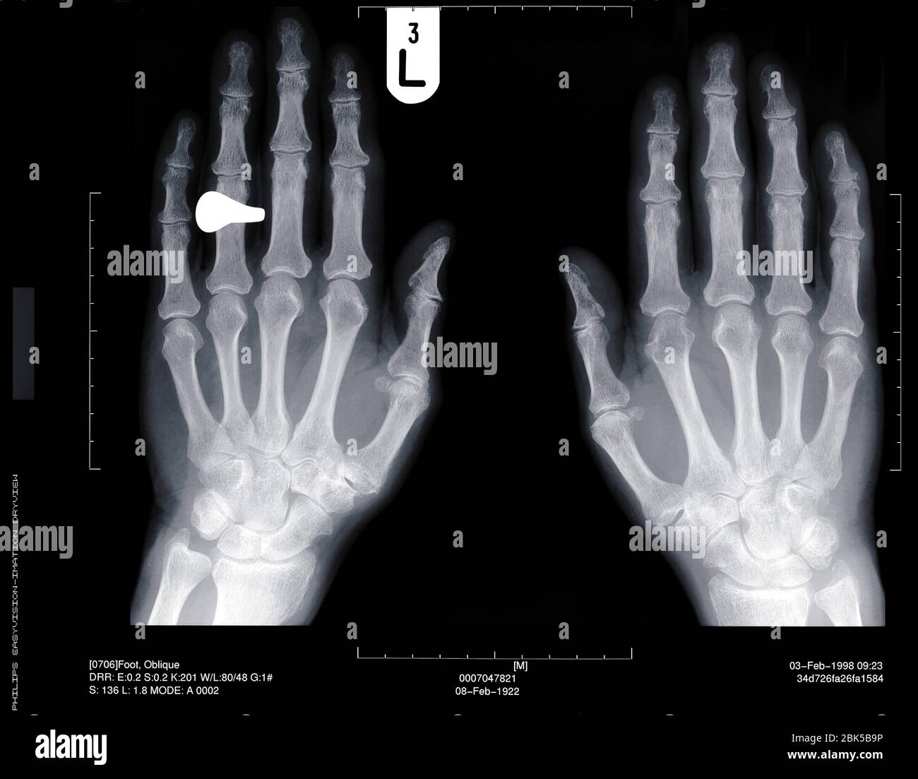 Hands and ring, X-ray. Stock Photo