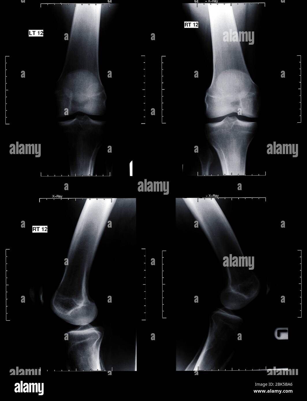 Human knee joints, X-ray. Stock Photo