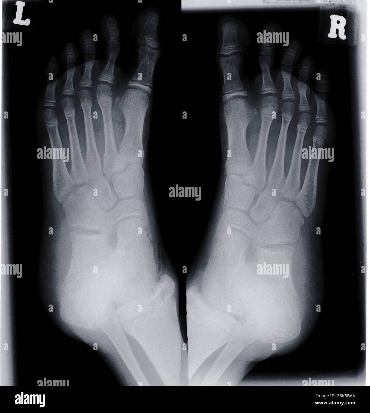 Human feet, X-ray. Stock Photo