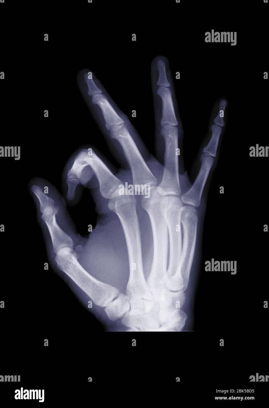 Hand making an OK gesture, X-ray. Stock Photo