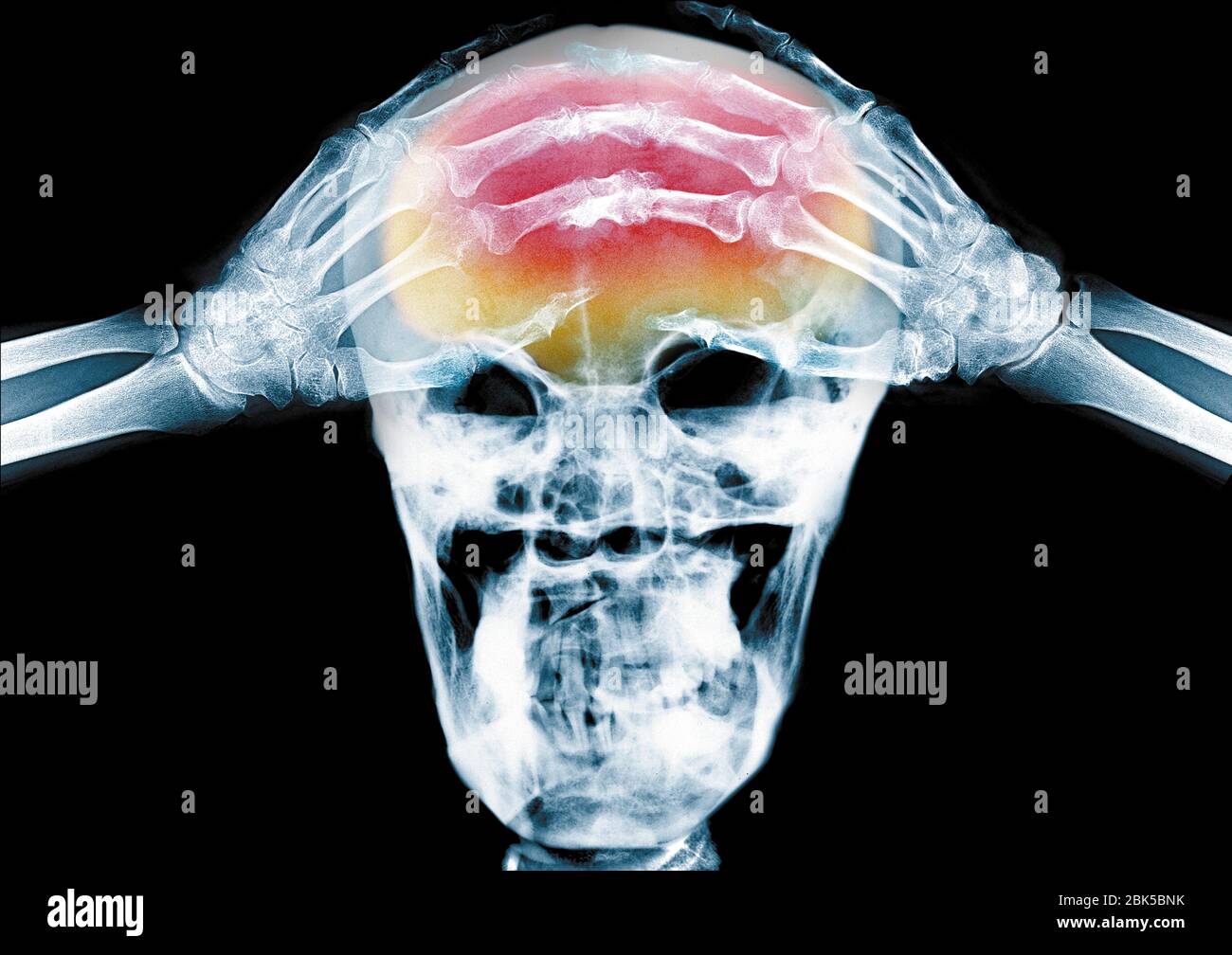 Person with hands on their head, headache, coloured X-ray. Stock Photo