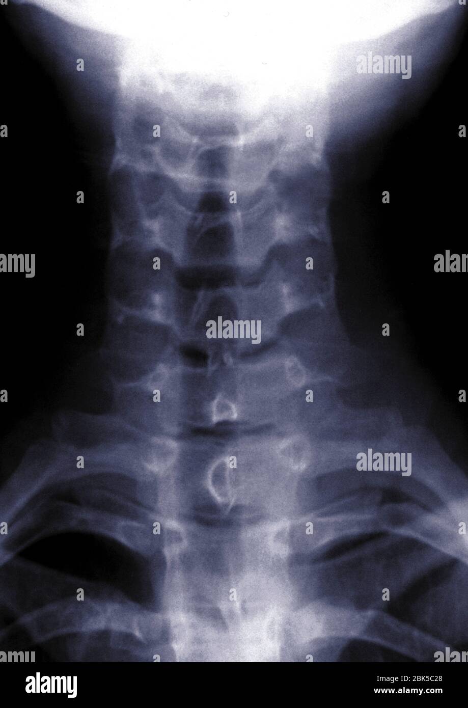 Vertebrae, X-ray. Stock Photo