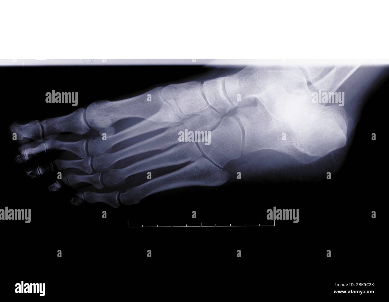 Foot, X-ray. Stock Photo
