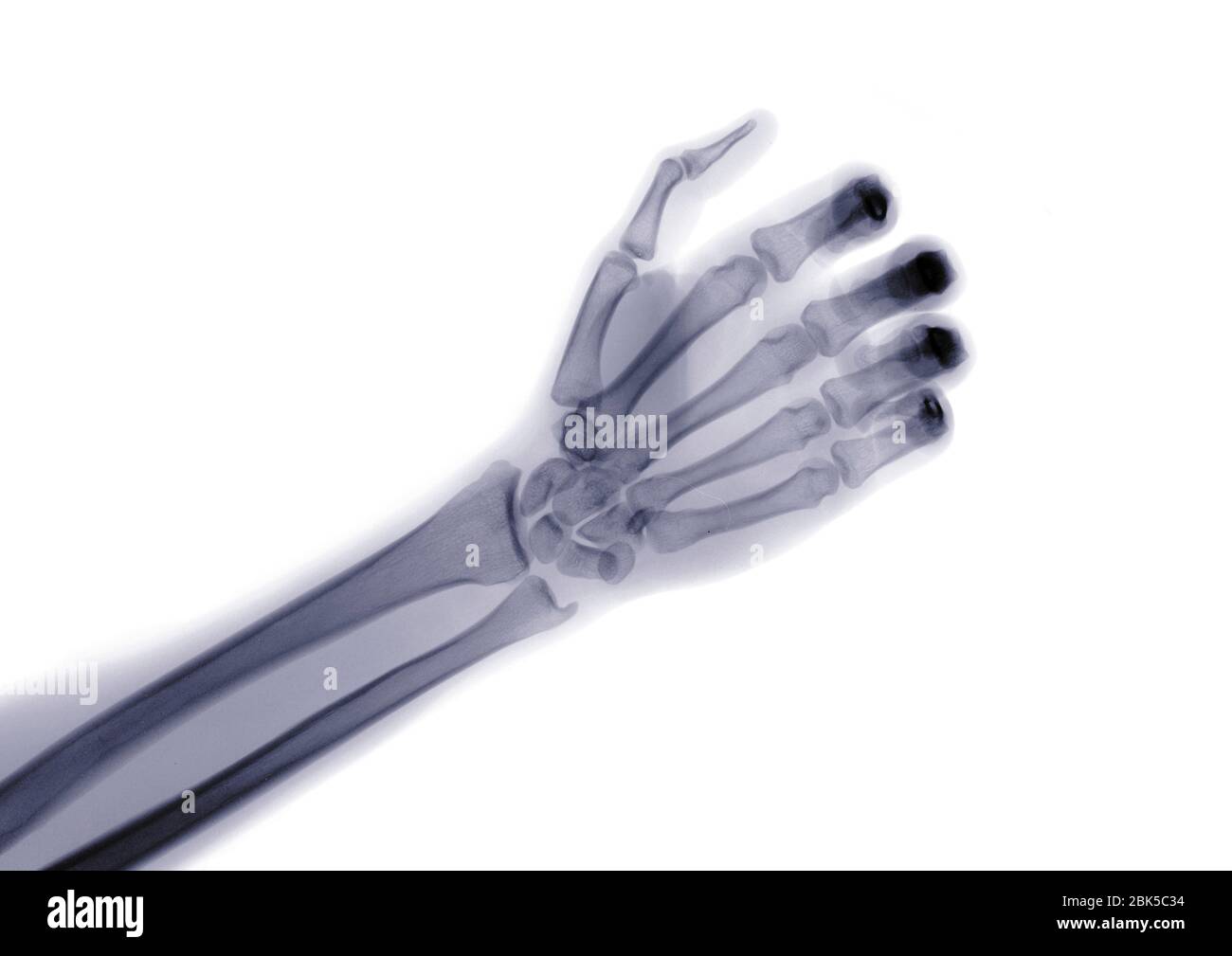Hand and arm, Xray Stock Photo Alamy