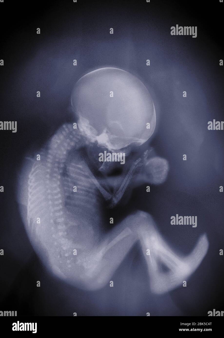 Baby in a fetal position, X-ray. Stock Photo
