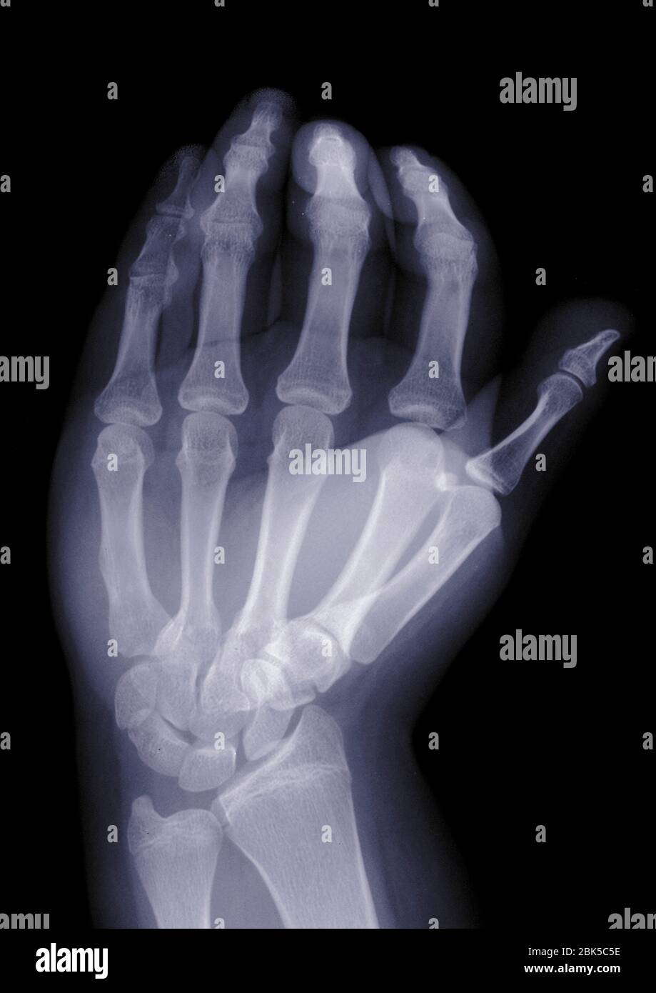 Hand shot from above, X-ray. Stock Photo