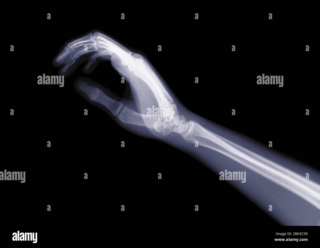 Hand and arm from the side, X-ray. Stock Photo