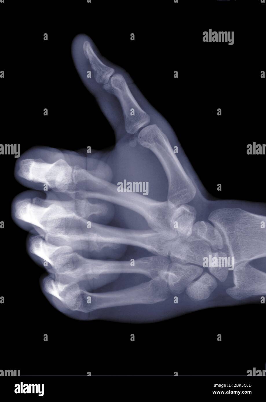 Hand with thumb up, X-ray. Stock Photo