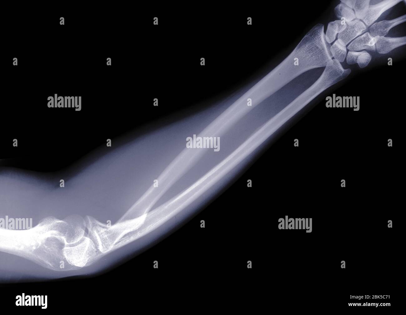 Arm and elbow, X-ray. Stock Photo