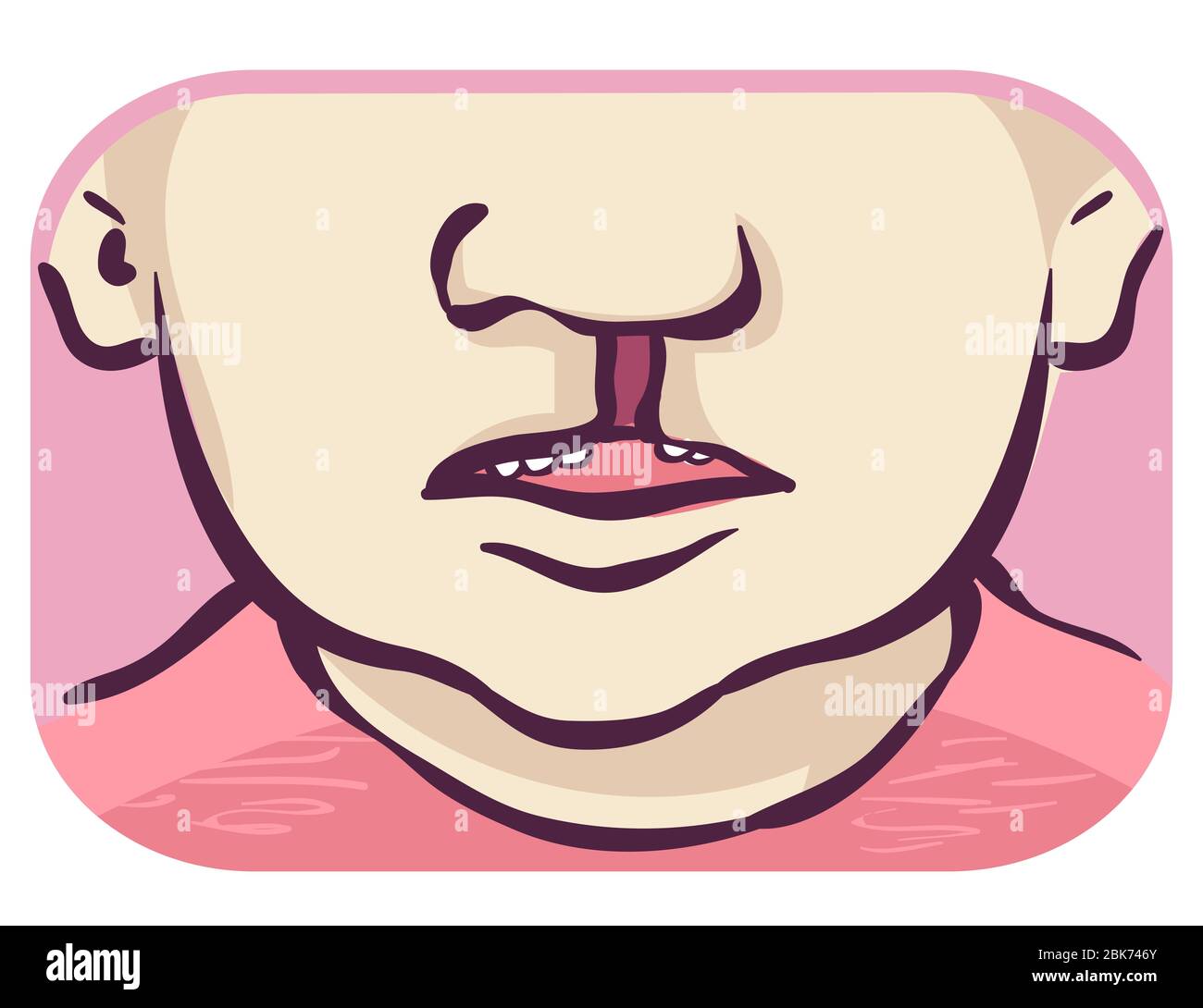 Illustration of a Young Face with Unilateral Cleft Lip with Cleft Palate Stock Photo