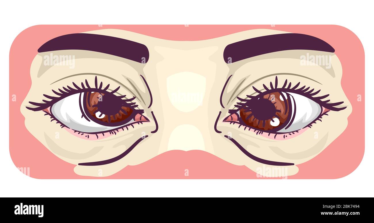 Cure For Crossed Eyes Clipart