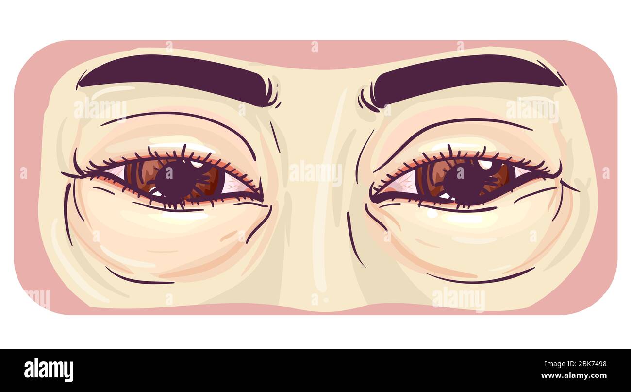 Illustration of Swollen and Puffy Eyes Stock Photo