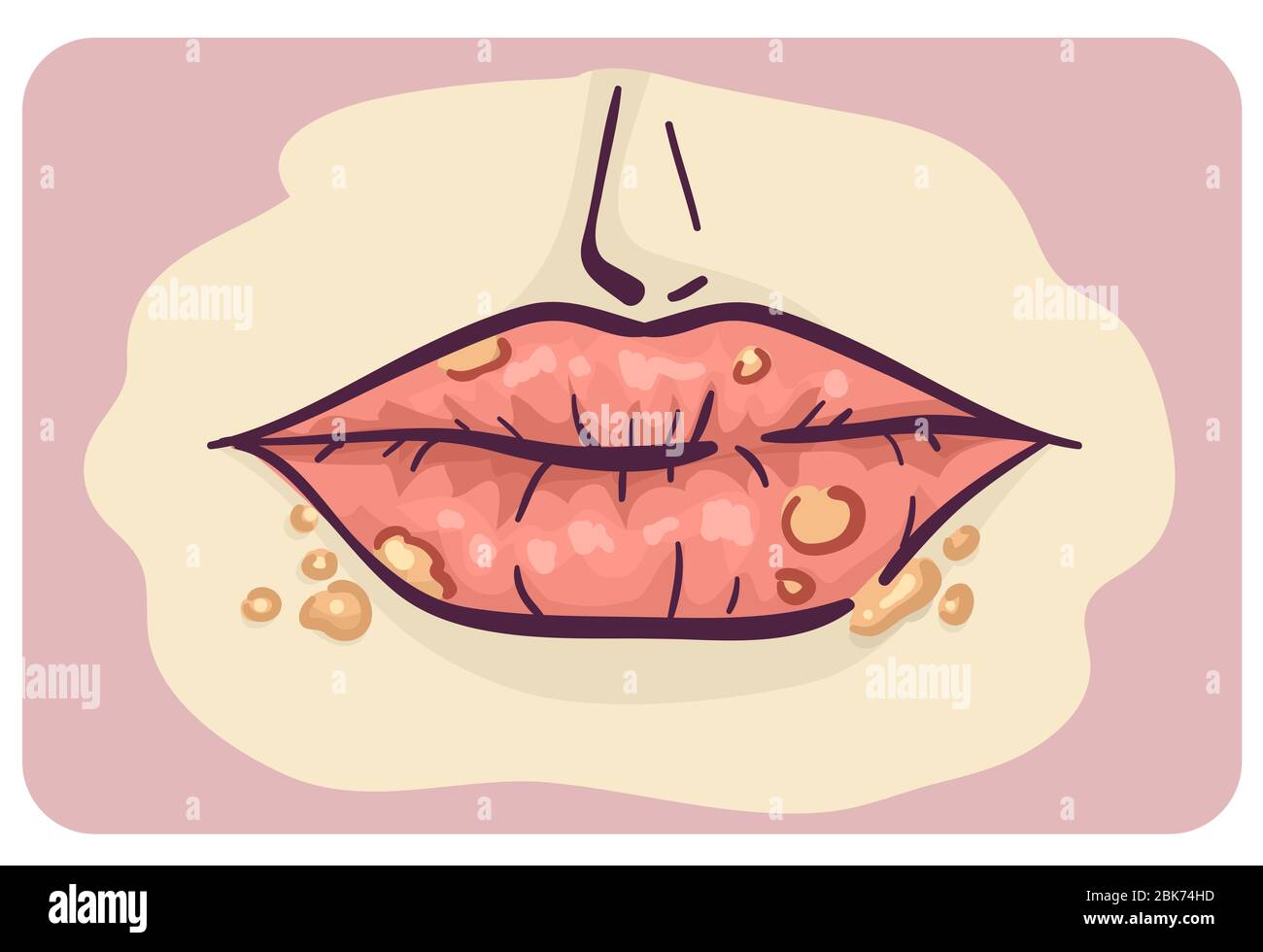Illustration of Lips with Cold Sores Symptom of Infection Stock Photo
