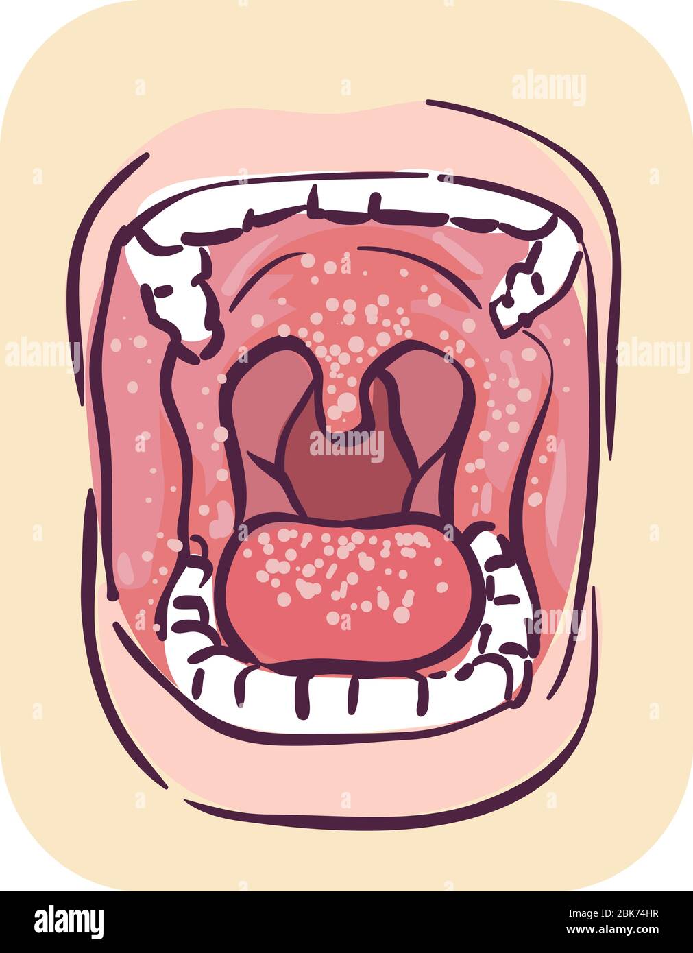 Illustration of Wide Opened Mouth with Oral Thrush Symptom of HIV Stock Photo