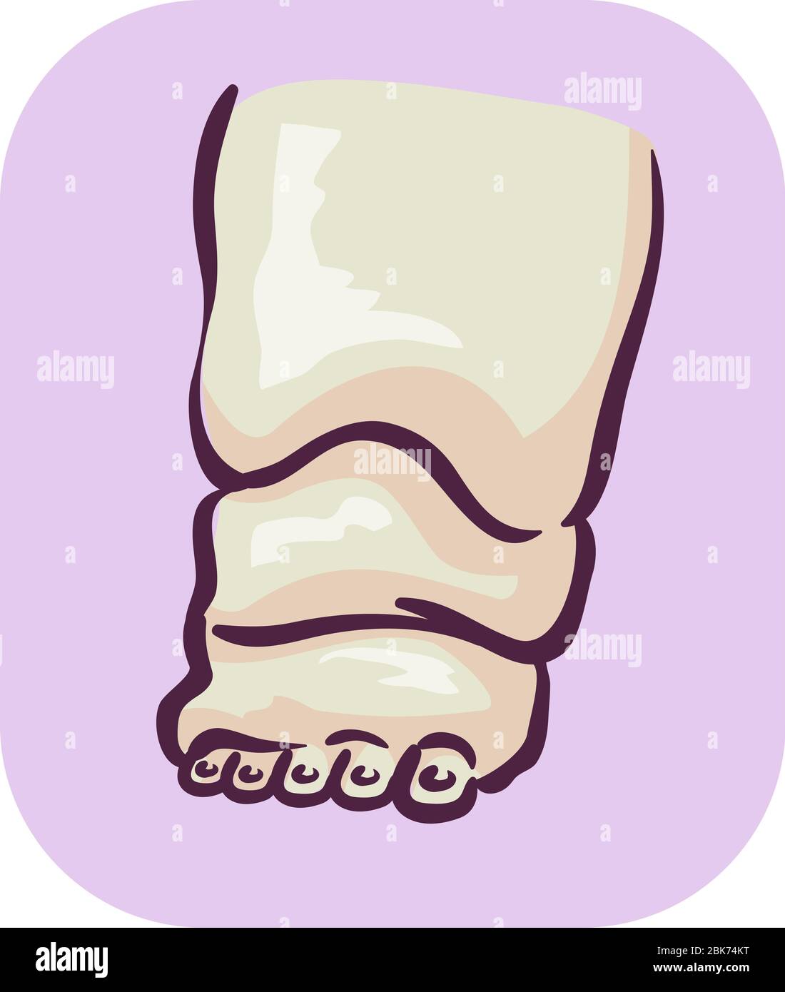 Illustration of Swollen Foot Symptom of Edema Stock Photo