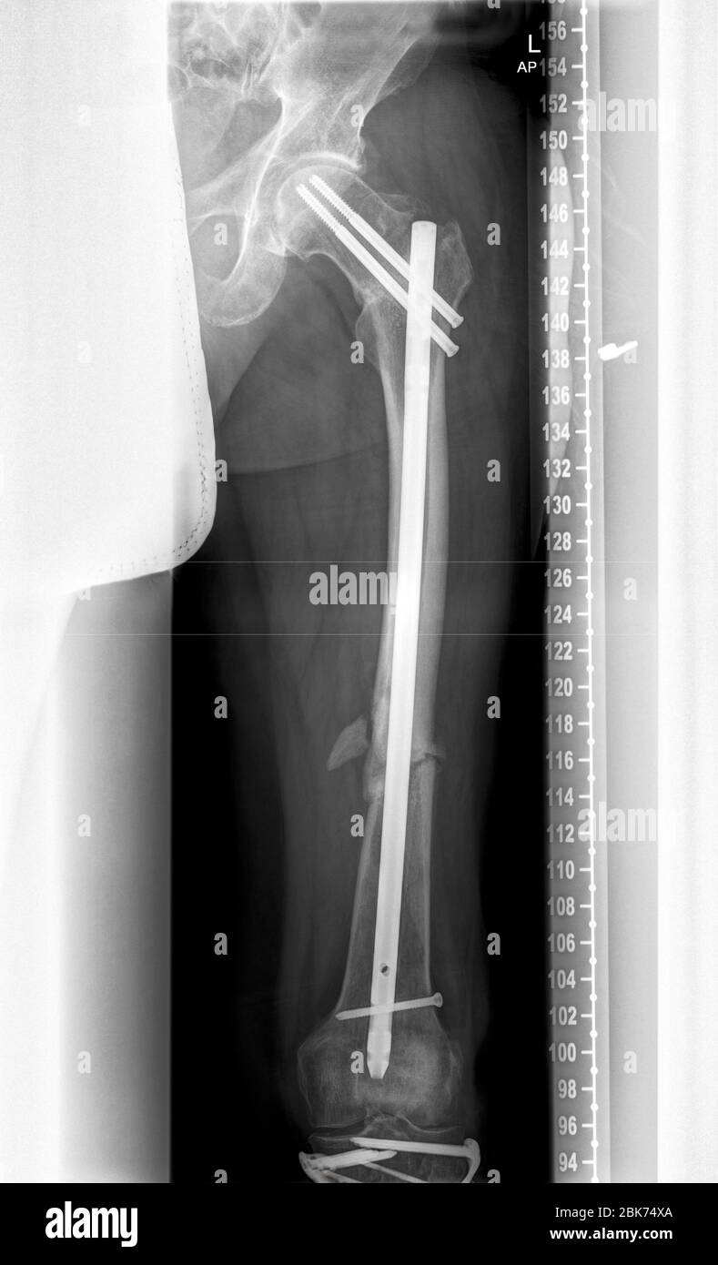 X-ray image of multiple fractures after a traffic accident Stock Photo