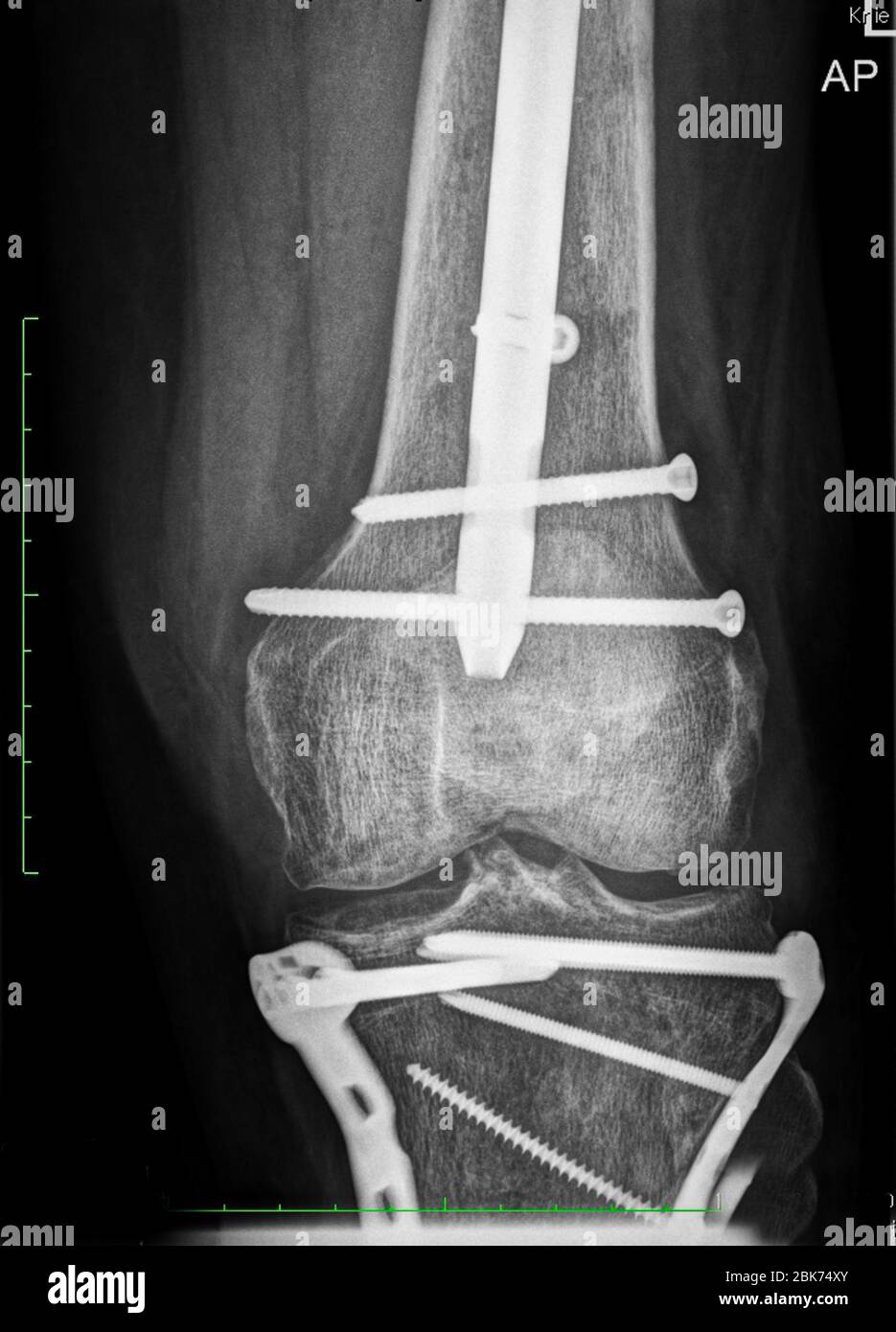 X-ray image of multiple fractures after a traffic accident Stock Photo