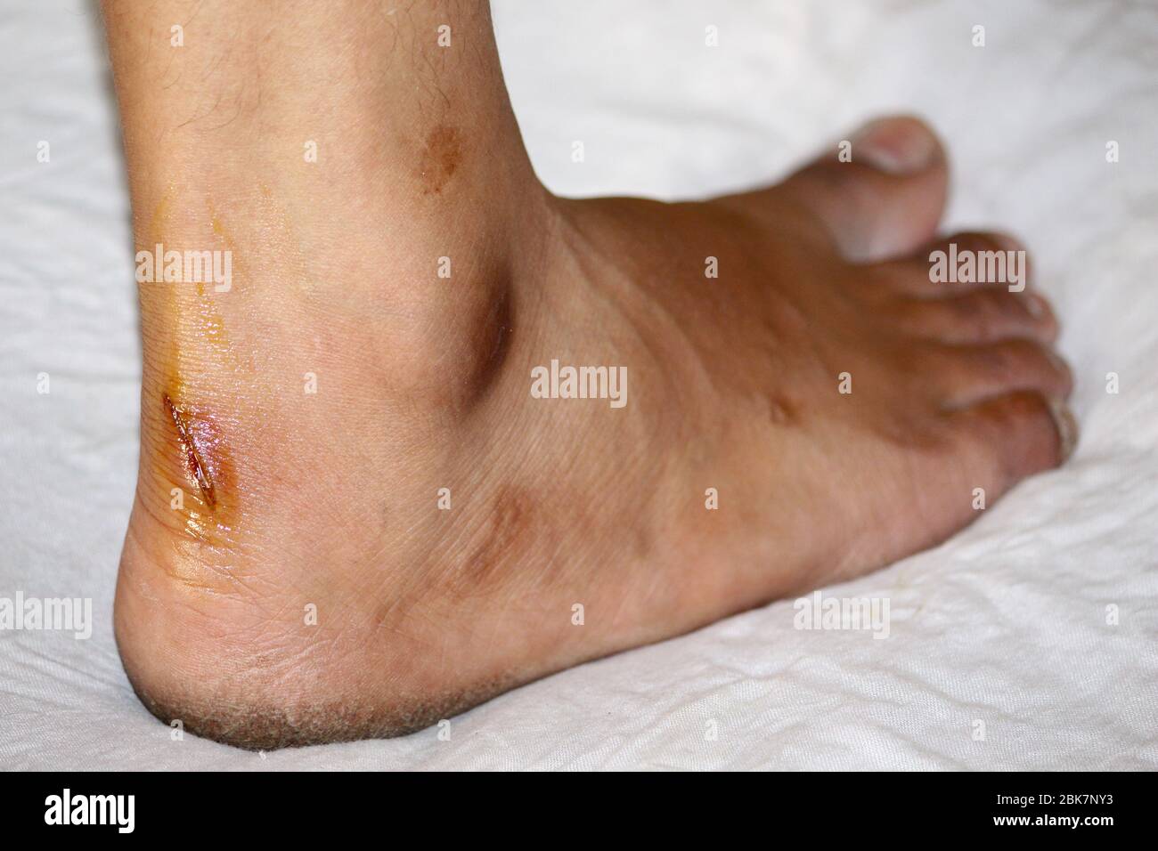 Infected leg wound hires stock photography and images Alamy