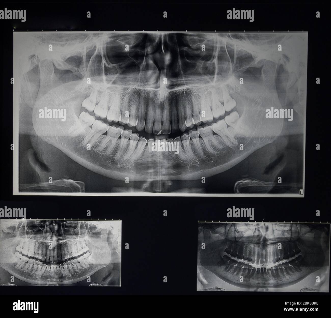 Ortopantomography odontostomalogical radiographs, digital orthopantomography for dental ...