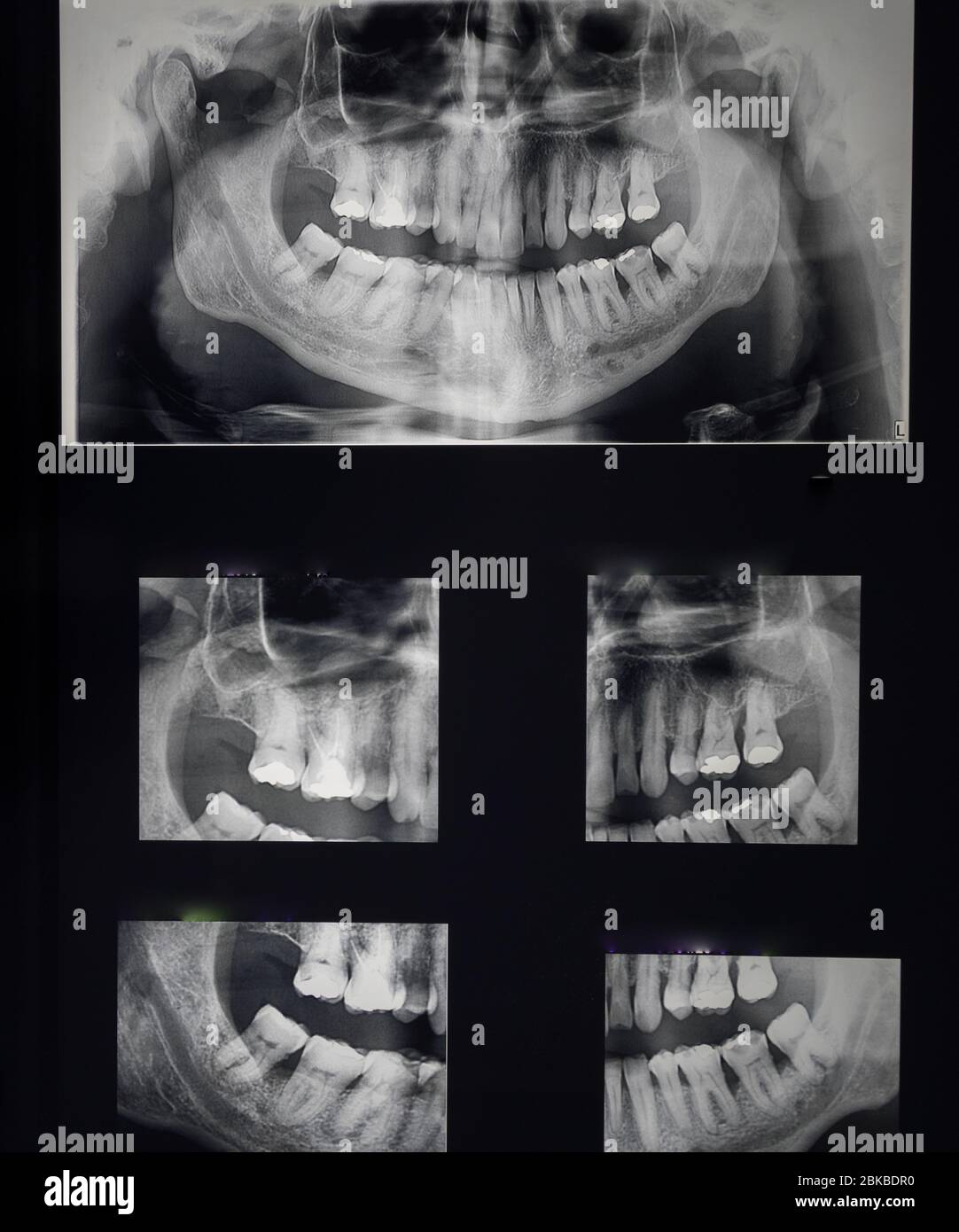 Ortopantomography odontostomalogical radiographs, digital orthopantomography for dental ...