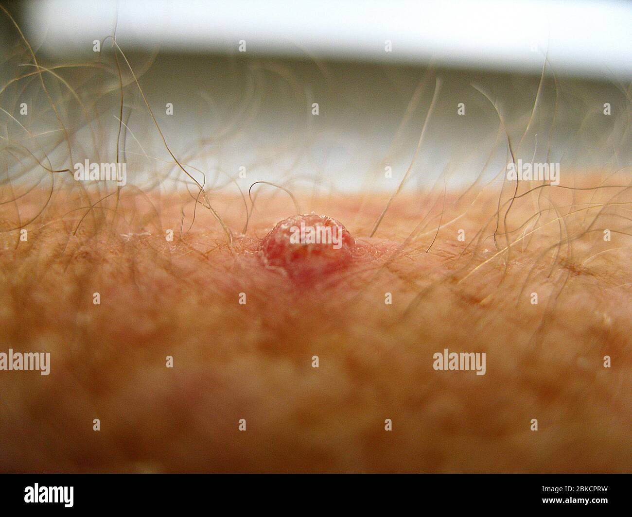 Skin cancer is evident in this angled view of a squamous cell carcinoma on the hairy arm of a Caucasian man. Most often caused by years of exposure to the sun's ultraviolet rays, it is one of the most common types of skin cancer. Treatment for such hard lumps with scaly tops is usually surgical removal by a dermatologist. Avoiding prolonged exposure to ultraviolet radiation and the use of sunscreen are recommended ways to prevent skin cancers. Stock Photo