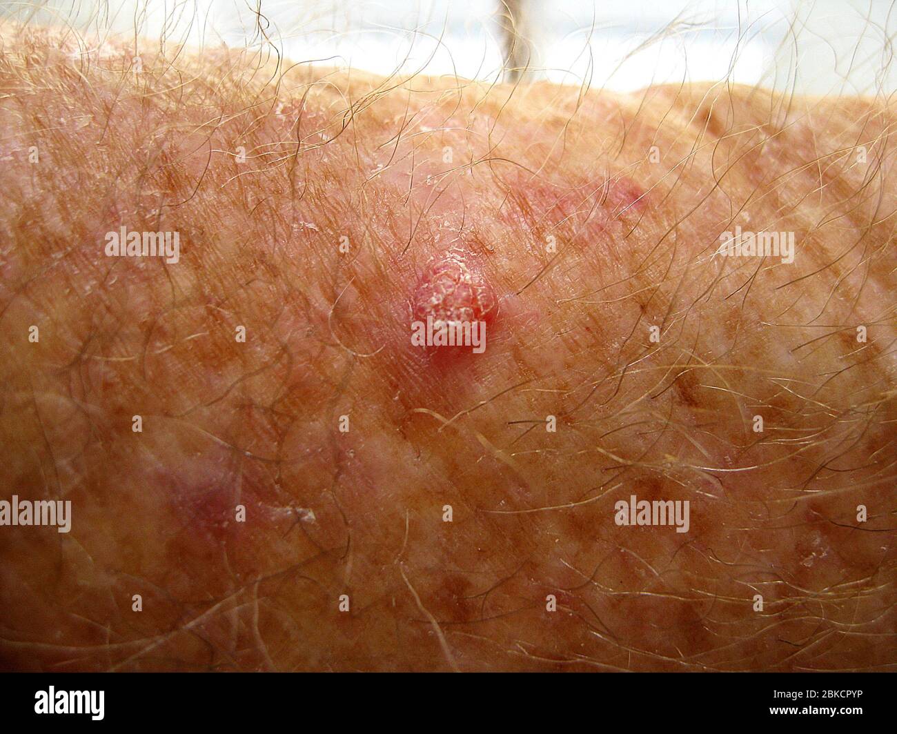 Skin cancer is evident in this top view of a squamous cell carcinoma on the hairy arm of a Caucasian man. Most often caused by years of exposure to the sun's ultraviolet (UV) rays, it is one of the most common types of skin cancer. Treatment for such hard lumps with scaly tops is usually surgical removal by a dermatologist. Avoiding prolonged exposure to ultraviolet radiation and the use of sunscreen are recommended ways to prevent skin cancers. Stock Photo
