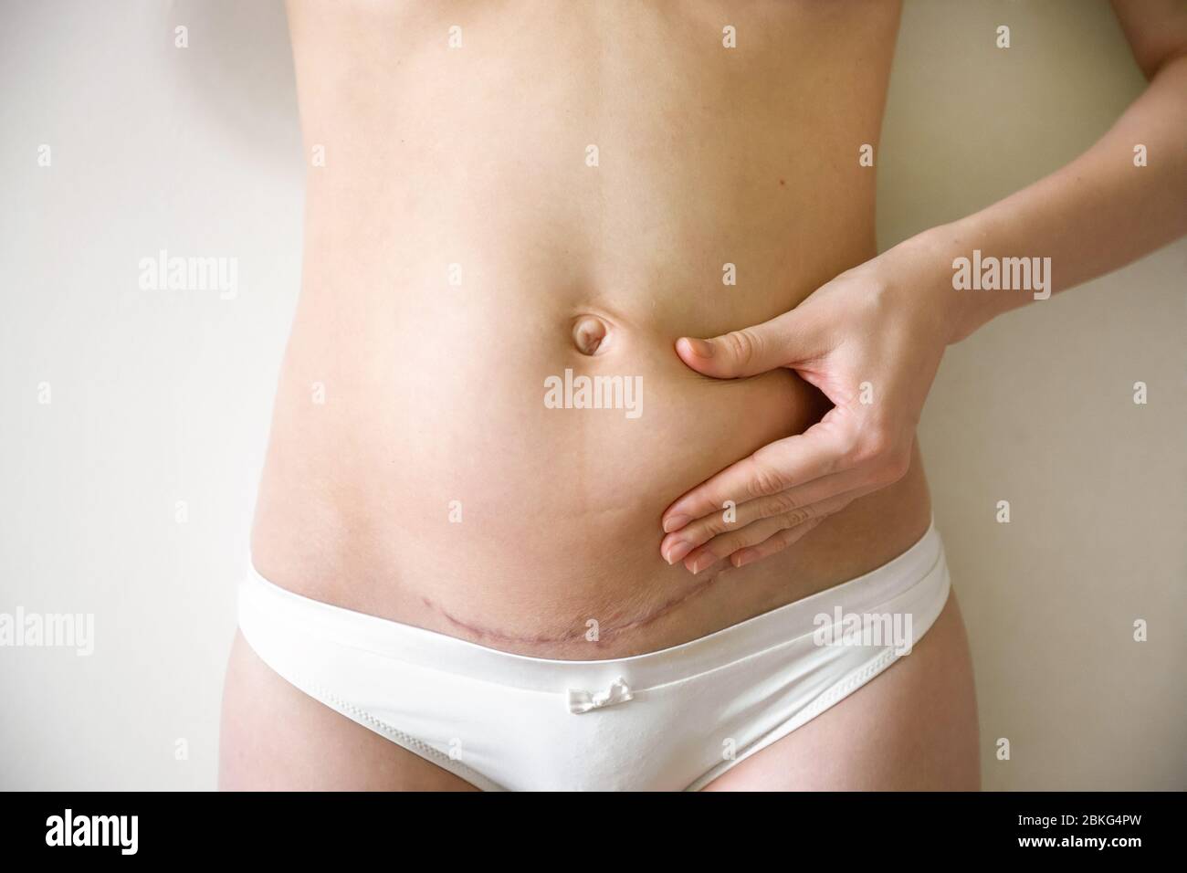 Woman grabbing the loose skin on stomach after giving birth by caserean section Stock Photo