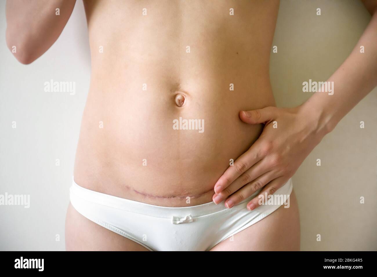 Closeup of woman belly with scar from a cesarean section Stock Photo