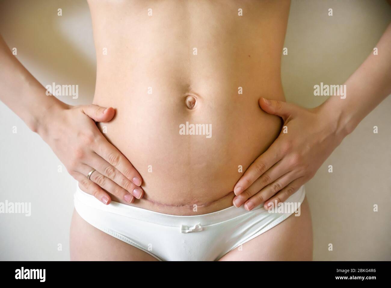 Closeup of woman belly with scar from a cesarean section Stock Photo