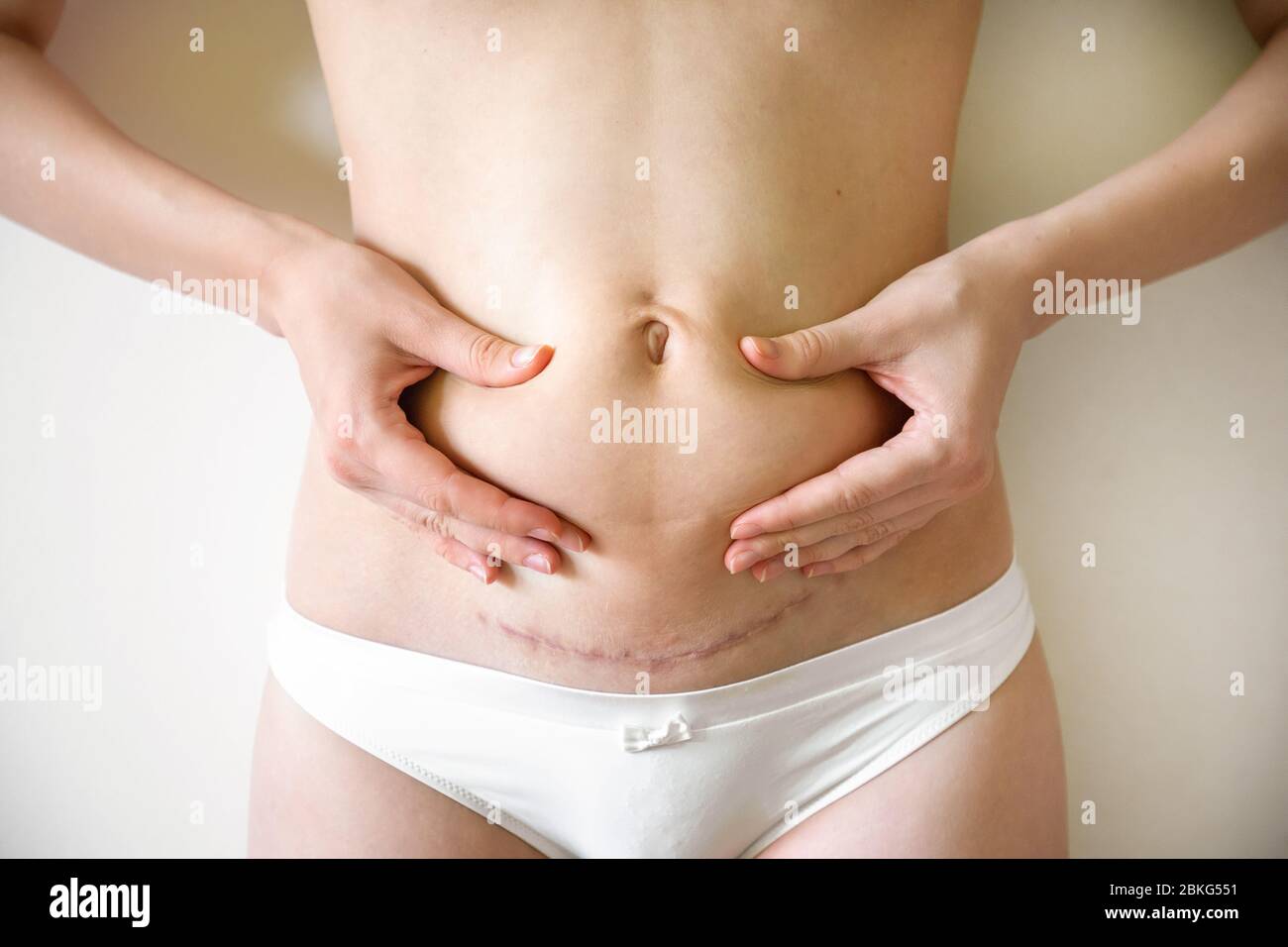 Woman grabbing the loose skin on stomach after giving birth by caserean section Stock Photo